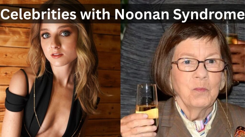 celebrities with noonan syndrome